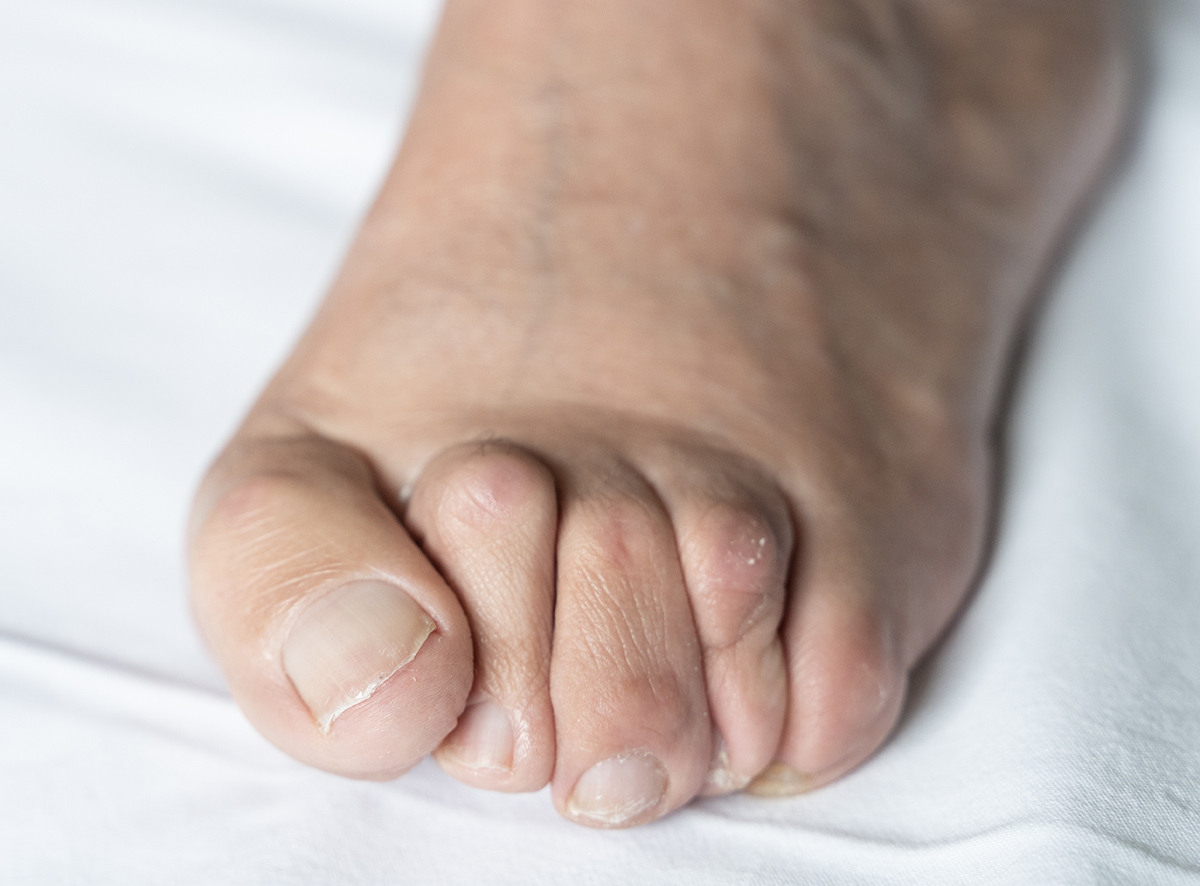 Hallux valgus und Hammerzeh